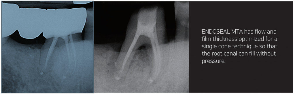 Endoseal MTA - NUDENT