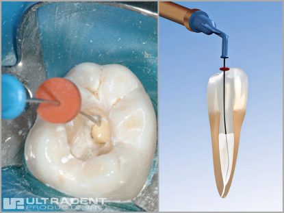 NaviTip tip’s small, flexible cannula easily delivers endodontic irrigants and sealers from the bottom of the apex to the top of the canal, eliminating air bubbles.