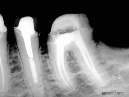 3_EndoREZ-results-in-predictable-fills-Clinical