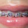 FLI®-Twin-Nudent6