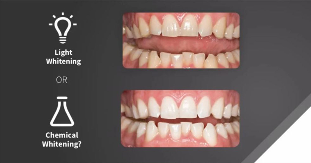 Talking to Your Patients About Light Vs No Light in Teeth Whitening