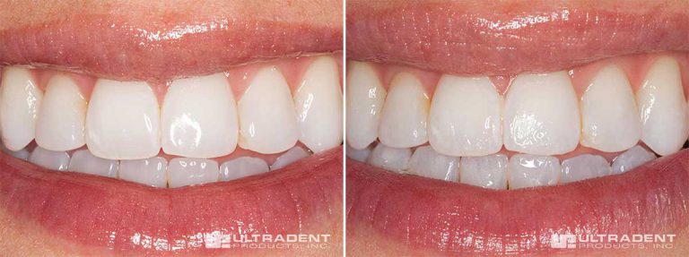 These before-and-after photos of an Enamelast fluoride varnish application show the smooth texture and nearly invisible appearance.