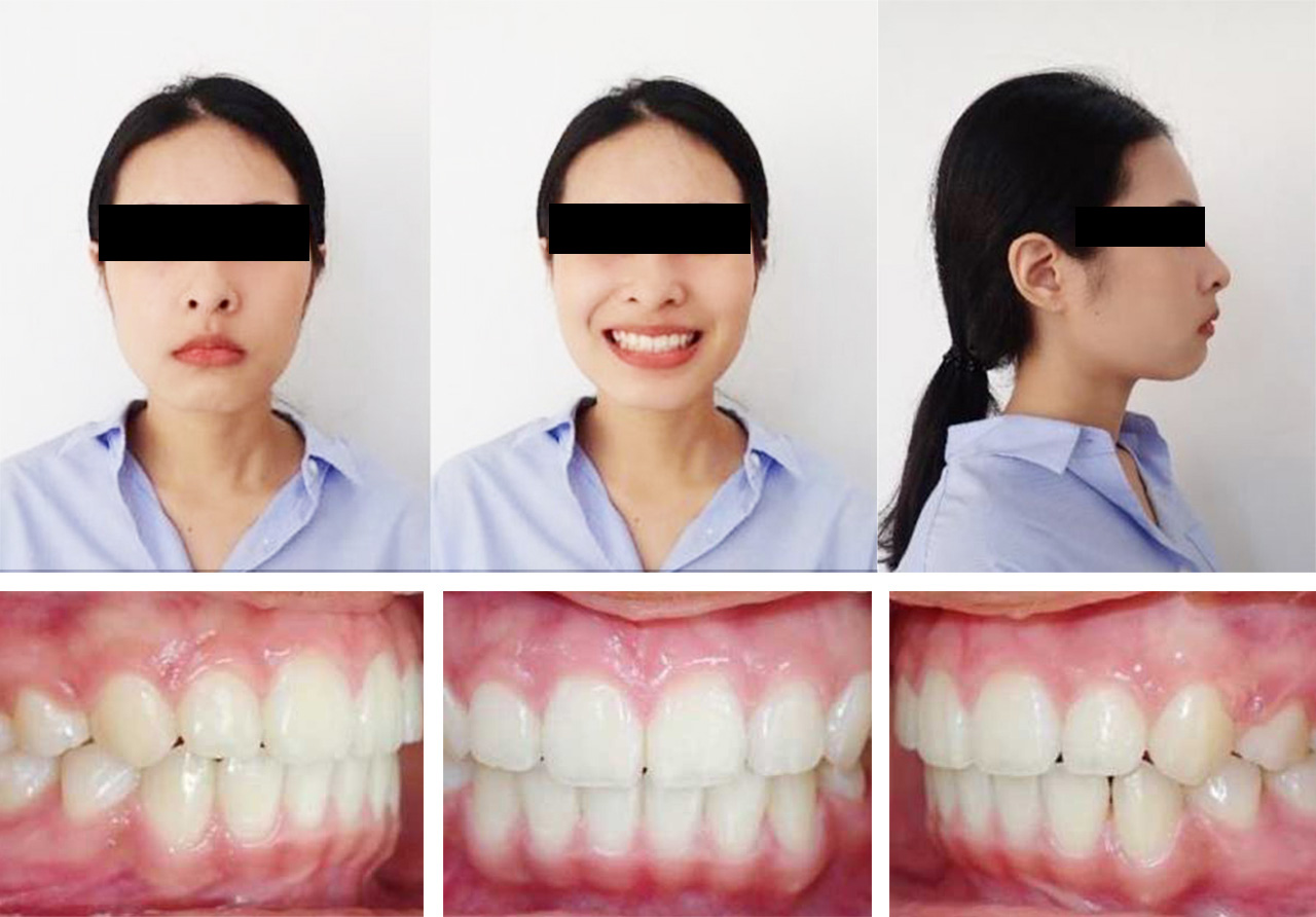 Bimaxillary Protrusion After