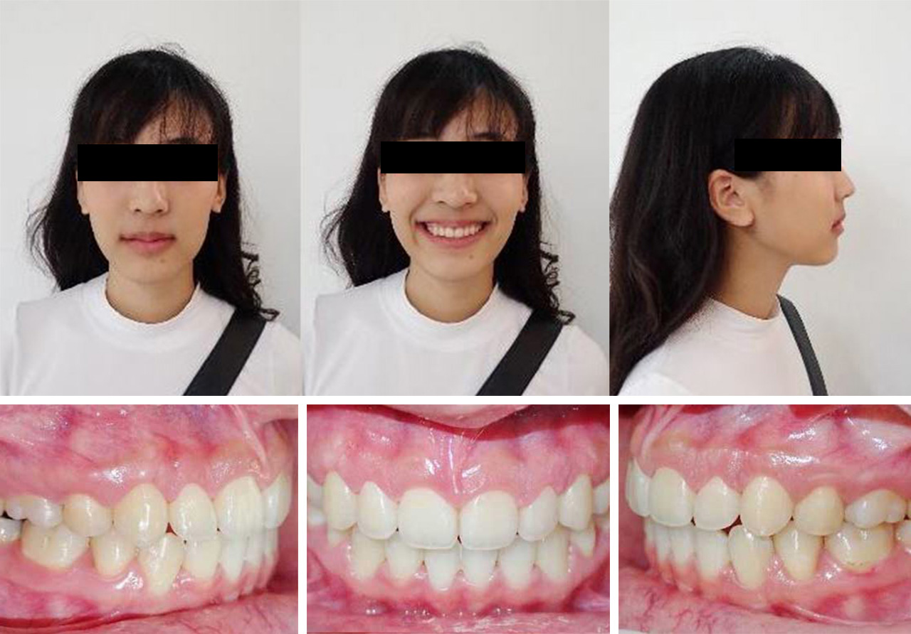 Gummy Smile After